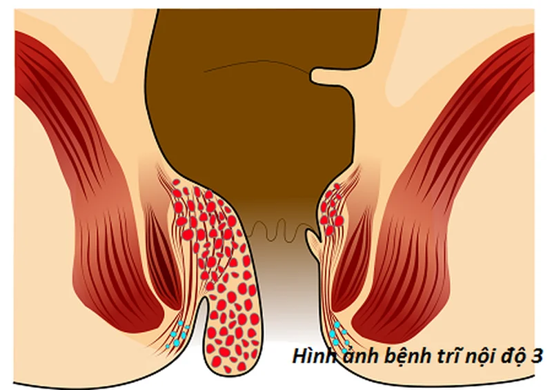 Hình ảnh bệnh trĩ nội và bệnh trĩ ngoại theo 4 cấp độ - Nhà thuốc FPT Long Châu