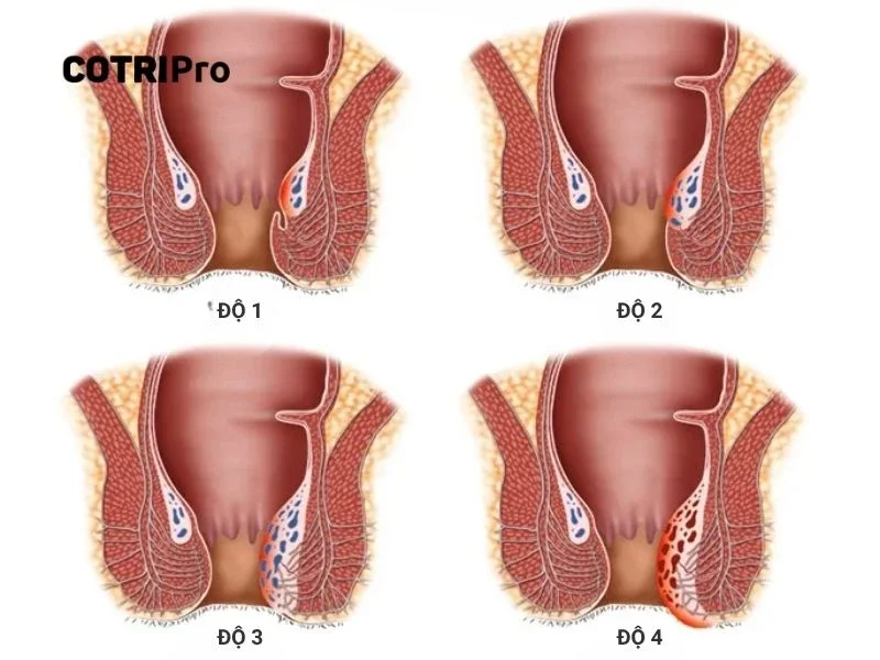 Bệnh trĩ nội độ 4: Nguy hiểm như nào và cách điều trị