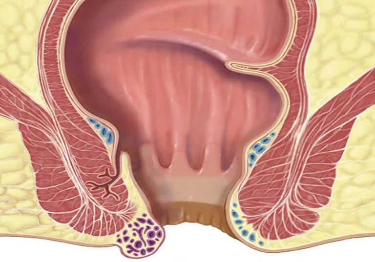 Trĩ Ngoại Độ 3 Là Như Thế Nào? Hình Ảnh Nhận Biết & Điều Trị