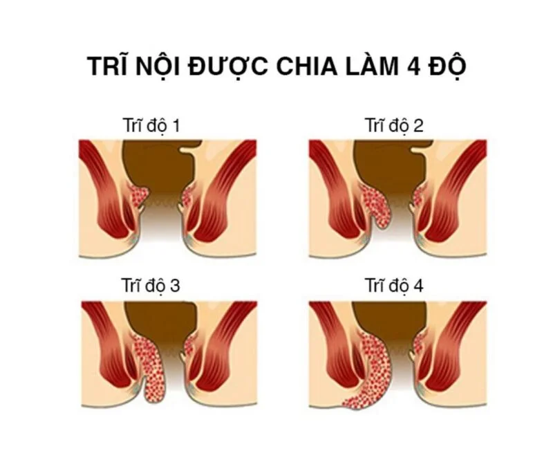 Biểu hiện của trĩ độ 4