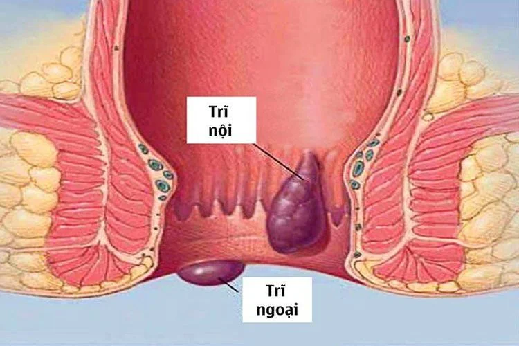 Trĩ nội độ 1-2 và trĩ ngoại bị sa ra ngoài.