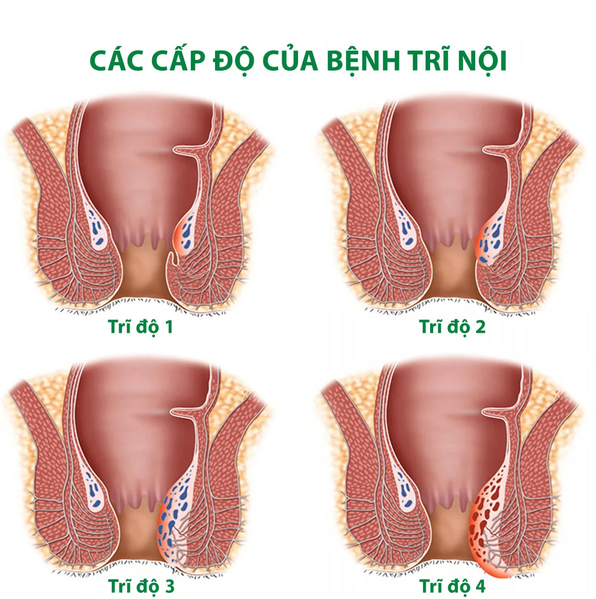 Trĩ nội hình ảnh qua 4 cấp độ và phương pháp điều trị bệnh tốt nhất